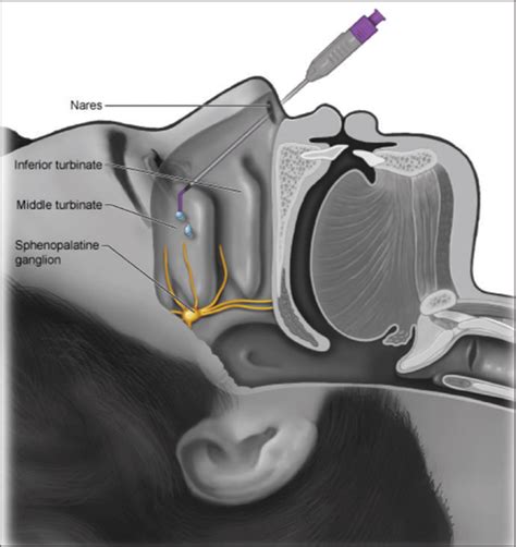 How We Do It: Sphenopalatine Ganglion Blockade for Migraine Treatment - American Journal of ...