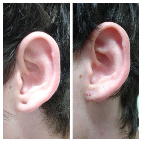 Ear Lobe Repair Surgery in Brisbane very experienced doctor