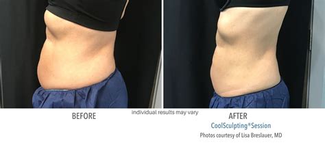 Coolsculpting Results One Treatment