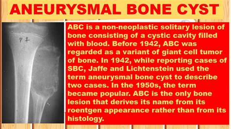 ANEURYSMAL BONE CYST - Radiology Classroom | Facebook