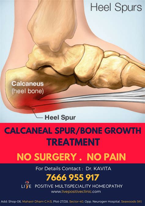 Homeopathic Cure of Calcaneal Spur [No Surgery] | LIVE POSITIVE