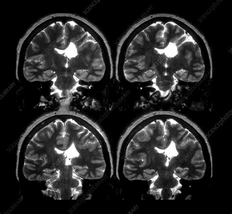 MRI Showing Schizencephaly - Stock Image - M260/0385 - Science Photo ...