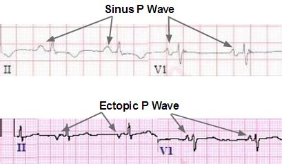 Ectopic Atrial Tachycardia Ecg