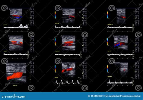 Ultrassom Doppler Para Detecção De Trombose Venosa Profunda Foto de ...