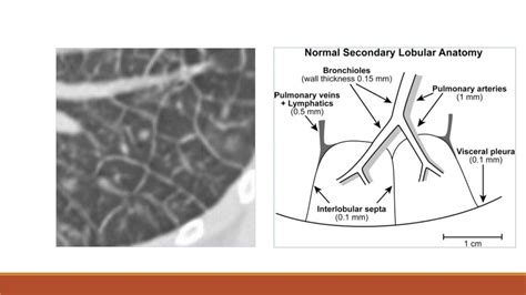 The Secondary Pulmonary Lobule