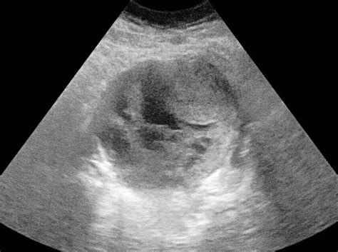 Ultrasound Pictures of Ovarian Cancer | MyOvarianCancerTeam