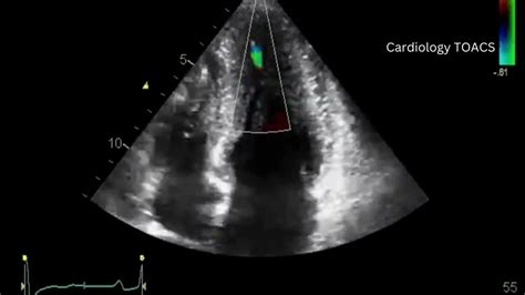 Apical Hypertrophic Cardiomyopathy | Yamaguchi Syndrome Echo | HCM ...