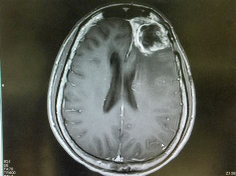 A History of the Classification of Glioma Brain Tumors