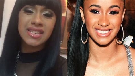 5 Celebrities with Veneers Who are Open About Their Experience