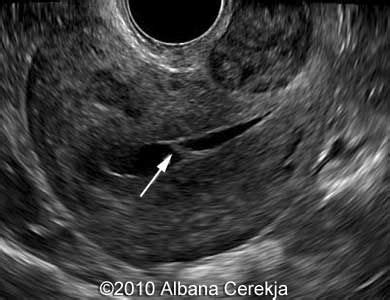 What Does Cancer Look Like On An Ultrasound Of The Uterus - What Does