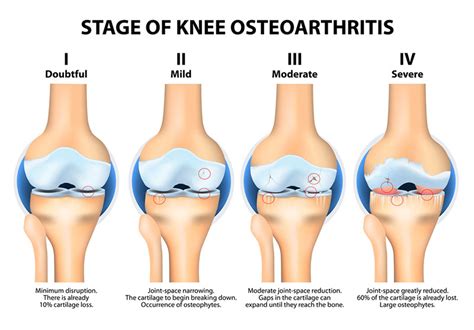 Knee Osteoarthritis | OASIS Orthopaedics Melbourne