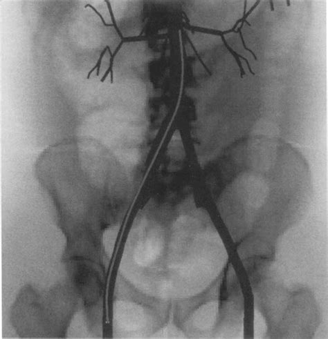 Simulator view of catheter passed from the femoral artery entry site to... | Download Scientific ...