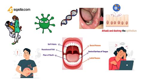 Recurrent Aphthous Stomatitis - Animation