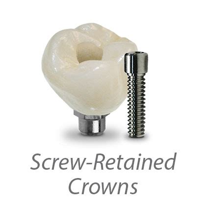 7148-Screw-Retained-Crowns-Thumb - Burdette Dental Laboratory