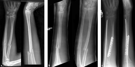 Ulna Bone Fracture