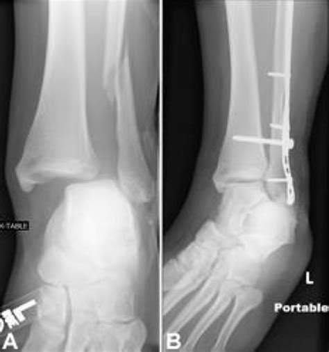 Broken Ankle - Fractured Ankle, Broken Foot, Stress Fracture Ankle