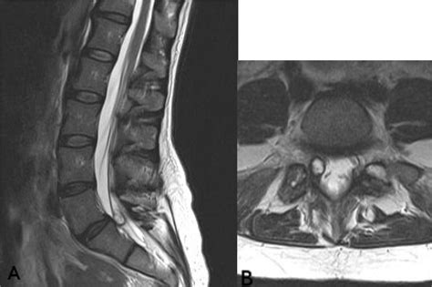 Synovial Cyst Lumbar Spine Removal - mapametawan