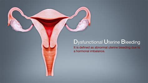 DYSFUNCTIONAL UTERINE BLEEDING: Symptoms, Causes, and Treatment ...