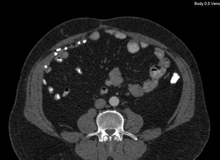 Abdominal Ventral Hernia Repair Mesh