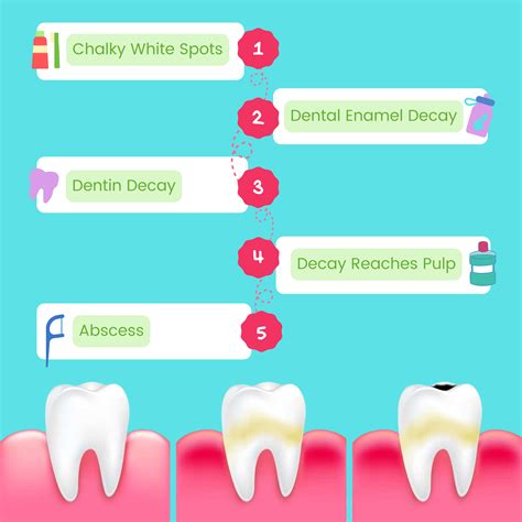 The Stages of Tooth Decay - Walton Blvd Dental