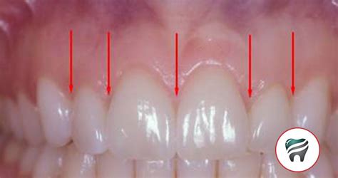 PREENCHIMENTO DE PAPILA INTERDENTAL COM ÁCIDO HIALURÔNICO - ORTOBLOG