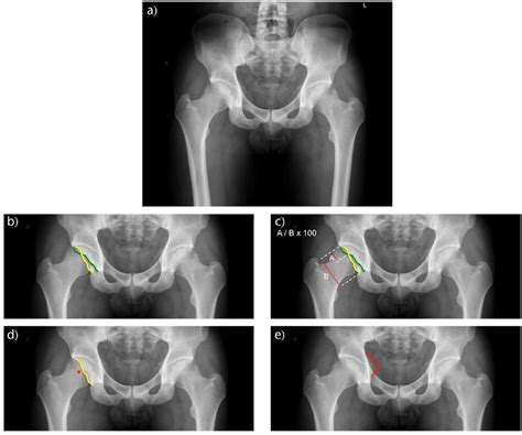 Acetabular retroversion: Diagnosis and treatment in: EFORT Open Reviews Volume 3 Issue 11 (2018)