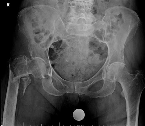 Intertrochanteric Fractures - Trauma - Orthobullets