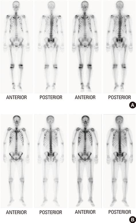 White Spots On Bone Scan