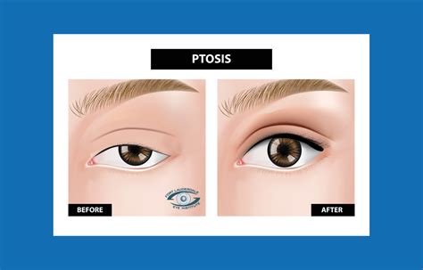 Ophthalmic Plastic Surgery Of The Upper Face: Eyelid Ptosis, Dermatochalasis, And Eyebrow Ptosis ...