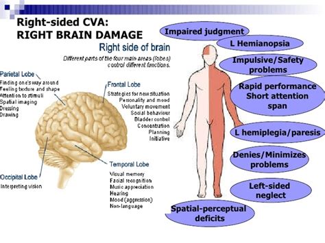 Right Hemisphere Stroke - Milka Clarke Stroke Brain Trauma Foundation