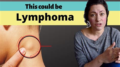 Swollen Lymph Nodes? It could be Lymphoma | Stage 4 Cancer - YouTube