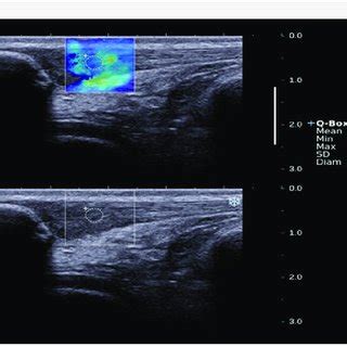 A: Illustration of a Two-dimensional SWE (2D-SWE) measurement performed ...