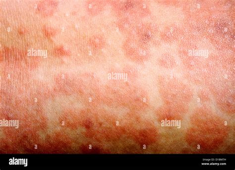 MEASLES RASH Stock Photo - Alamy