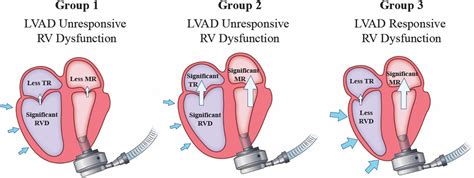 Frontiers | Role of the mitral valve in left ventricular assist device pathophysiology