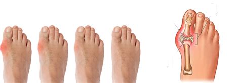 One Probable Cause Of Hyperuricemia That You Need To Know - Get Rid Of Gout