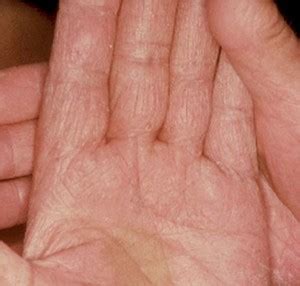 👉 Hand Fungus - Pictures, Symptoms, Treatment and Causes (February 2022)