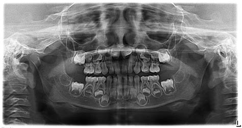 Baby Teeth Panoramic Xray | linkskadel