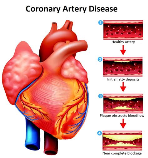 Global Coronary Artery Disease Treatment Devices Market Research Report ...