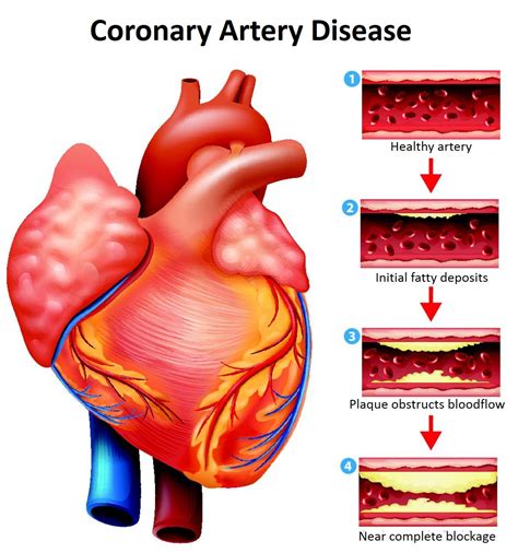 Global Coronary Artery Disease Treatment Devices Market Research Report 2016