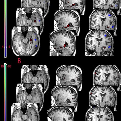 Example of patient (#1) suffering from left temporal lobe epilepsy due ...