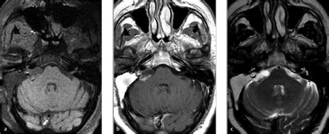 25 Tumors of the Cerebellopontine Angle | Neupsy Key