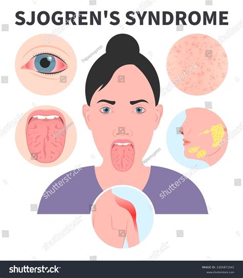 Sjogren's Syndrome dry eye Lymph nodes redness - Royalty Free Stock ...