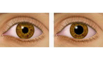 Pupil dilation illustrated depicting large and small pupil