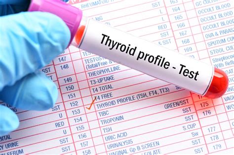 High Free T4 Levels Within Reference Range Associated With Atrial ...