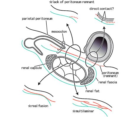 Summary of variations in fascial structures behind the colon Although... | Download Scientific ...