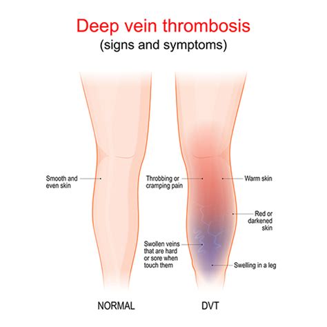 Deep Vein Thrombosis Treatment Center in Manhattan, Brooklyn, and NYC