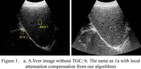 Figure 1 from Estimation of Ultrasound Attenuation and its Application ...