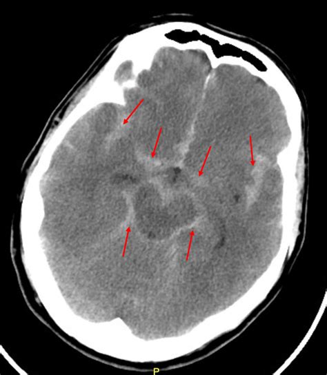 Subarachnoid hemorrhage on CT head | Download Scientific Diagram