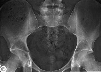 Acetabular retroversion as a rare cause of chronic hip pain ...