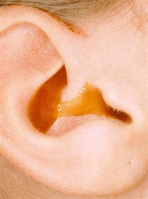 Ear Drainage Otorrhea